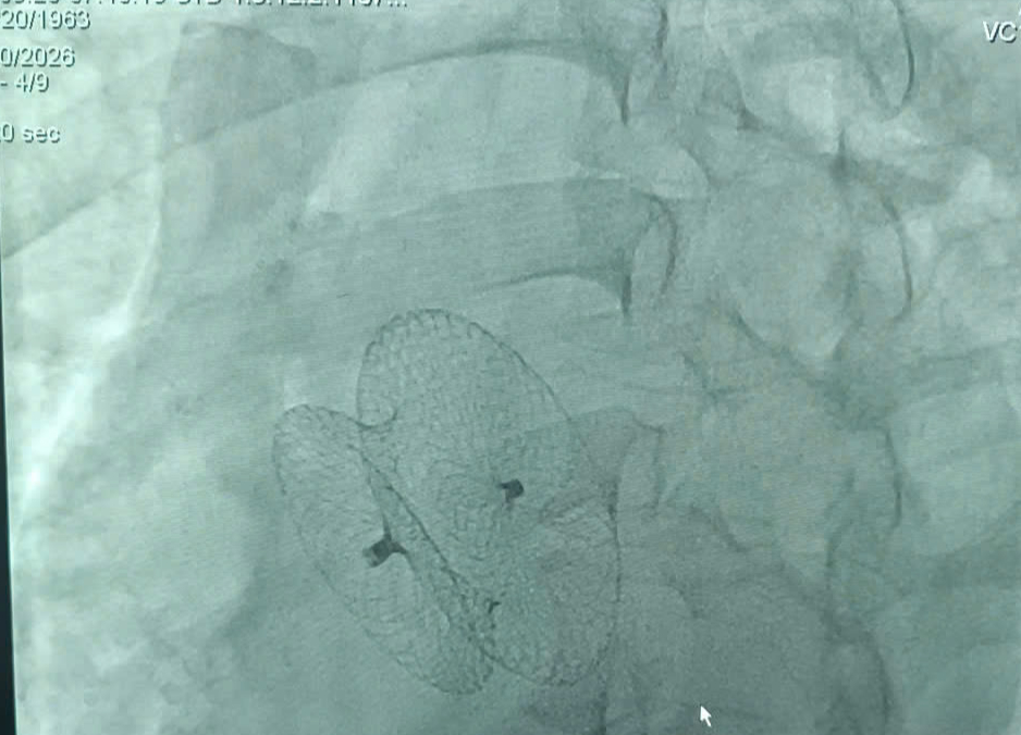 Hồi hộp, tim đập nhanh kéo dài, phát hiện bệnh tim nguy hiểm- Ảnh 1. Hồi hộp, tim đập nhanh kéo dài, phát hiện bệnh tim nguy hiểm- Ảnh 1.