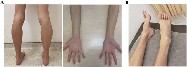 Gia tộc Samsung v&agrave; căn bệnh di truyền đ&aacute;ng sợ mang t&ecirc;n teo cơ M&Aacute;C: C&oacute; tất cả nhưng cũng kh&ocirc;ng thể chữa khỏi- Ảnh 7.