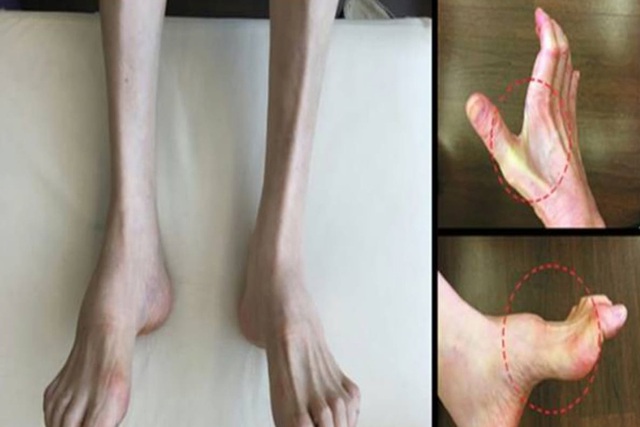 Gia tộc Samsung v&agrave; căn bệnh di truyền đ&aacute;ng sợ mang t&ecirc;n teo cơ M&Aacute;C: C&oacute; tất cả nhưng cũng kh&ocirc;ng thể chữa khỏi- Ảnh 4.