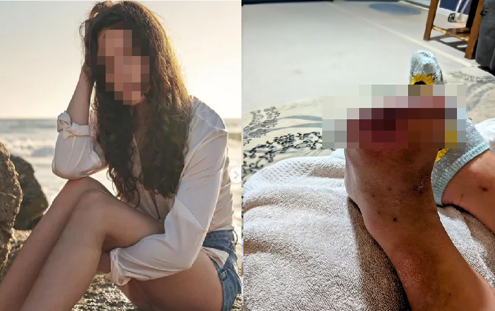 C&ocirc; g&aacute;i 20 tuổi hoại tử, phải cắt bỏ 2 ng&oacute;n ch&acirc;n v&igrave; mỗi ng&agrave;y đều uống 1 loại nước "vạn người th&iacute;ch"- Ảnh 1.