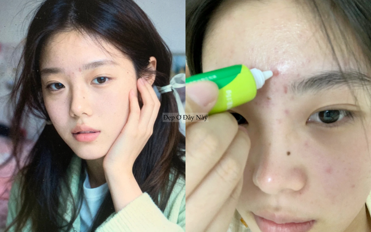 5 lọ kem chấm mụn "made in Vietnam" vừa xẹp mụn nhanh vừa ngừa th&acirc;m rất ổn- Ảnh 1.