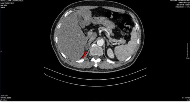 Người đ&agrave;n &ocirc;ng ph&aacute;t hiện mắc hai bệnh ung thư c&ugrave;ng l&uacute;c- Ảnh 2.