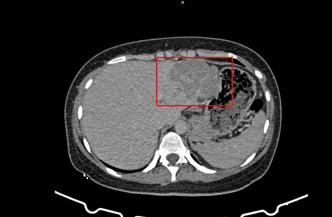 C&ocirc; g&aacute;i trẻ bị ung thư gan &lsquo;đ&aacute;nh &uacute;p&rsquo; sau 2 th&aacute;ng đau &acirc;m ỉ- Ảnh 1.