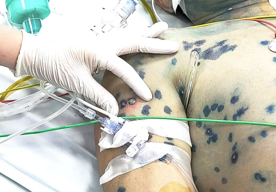 Ng&agrave;y c&agrave;ng nhiều người lớn bị thủy đậu: Bệnh viện Bệnh Nhiệt đới Trung ương cảnh b&aacute;o KHẨN- Ảnh 3.