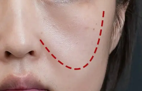 Tr&aacute;nh sai lầm khi chống l&atilde;o h&oacute;a v&ugrave;ng &ldquo;m&aacute; hồng&ldquo;: Đừng vội ti&ecirc;m chất l&agrave;m đầy, h&atilde;y l&agrave;m việc n&agrave;y trước để trẻ lại- Ảnh 1.