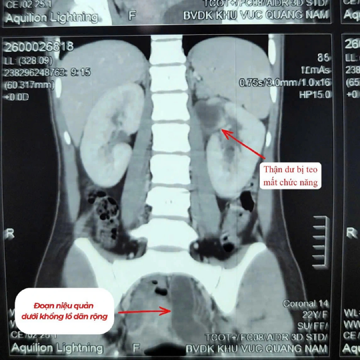 Kỳ lạ c&ocirc; g&aacute;i 22 tuổi c&oacute; 3 quả thận- Ảnh 1.