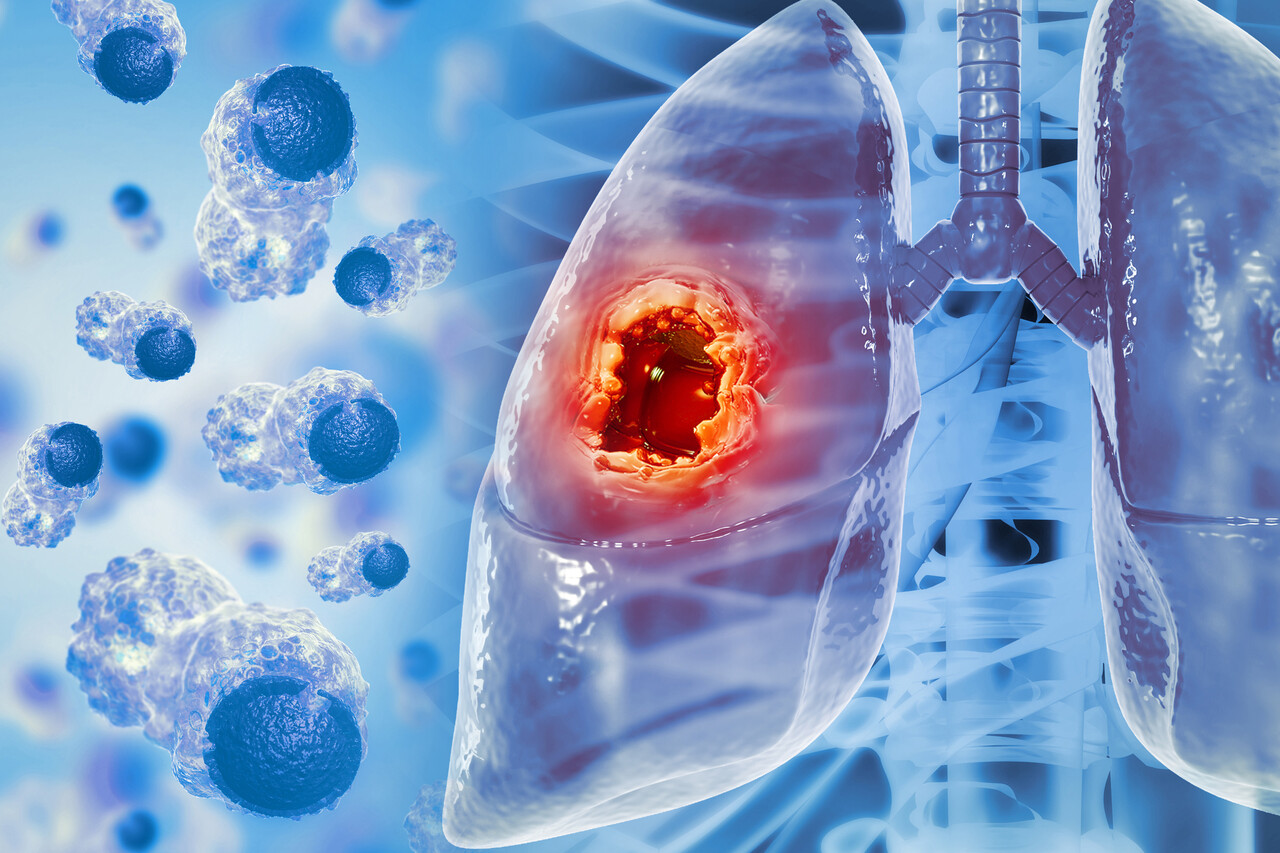 Loại ung thư đứng thứ 2 về tỉ lệ tử vong tại Việt Nam: 5 dấu hiệu sớm nhất ai cũng n&ecirc;n biết- Ảnh 1.