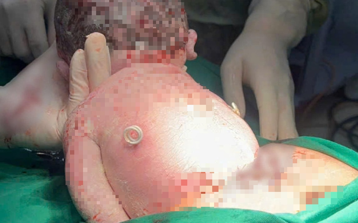 Em b&eacute; sinh ra với 