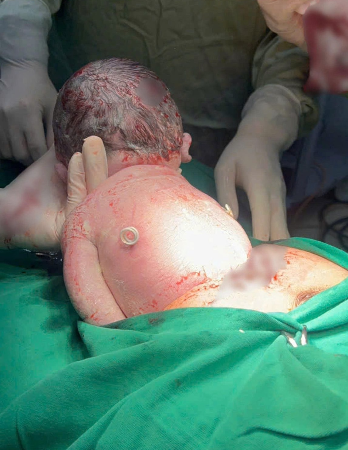 Em b&eacute; sinh ra với "đ&ocirc;i c&aacute;nh nhỏ" tr&ecirc;n lưng: Mẹ ơi! Con đến với mẹ rồi đ&acirc;y!- Ảnh 4.