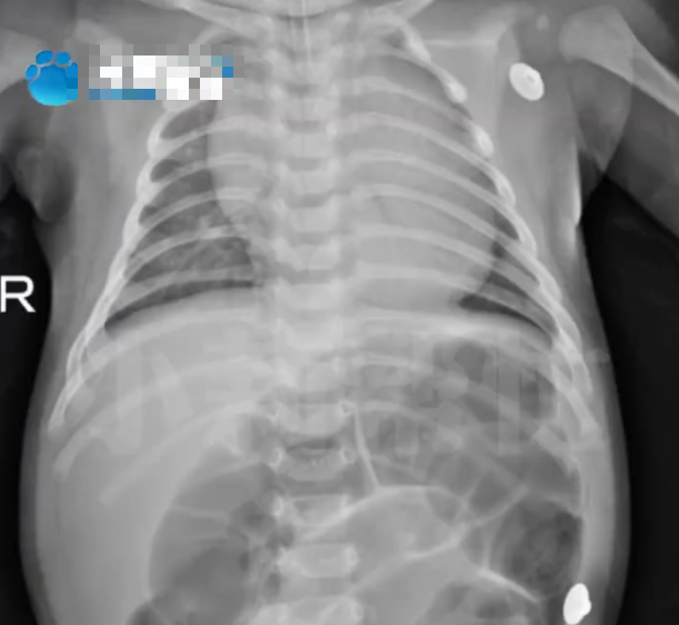 Em b&eacute; 52 ng&agrave;y tuổi ngộ độc Botulinum nguy kịch v&igrave; loại nước chữa ho, bổ phổi rất quen từ b&agrave; ngoại- Ảnh 1.