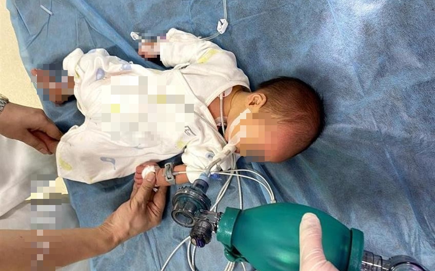 Em b&eacute; 52 ng&agrave;y tuổi ngộ độc Botulinum nguy kịch v&igrave; loại nước chữa ho, bổ phổi rất quen từ b&agrave; ngoại