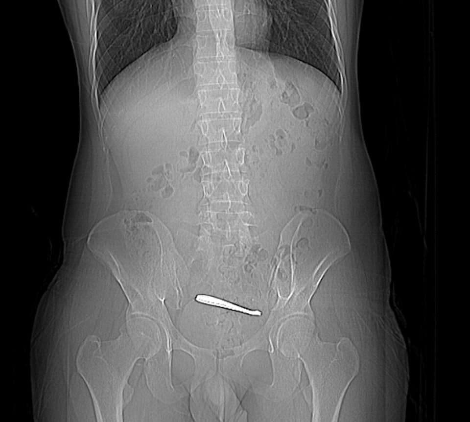 Người đ&agrave;n &ocirc;ng đau bụng suốt 1 tuần, b&aacute;c sĩ kiểm tra th&igrave; sốc nặng- Ảnh 1.