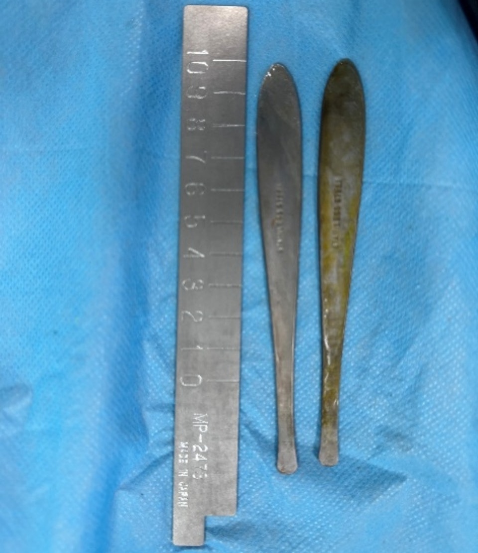 Người đ&agrave;n &ocirc;ng đau bụng suốt 1 tuần, b&aacute;c sĩ kiểm tra th&igrave; sốc nặng- Ảnh 2.