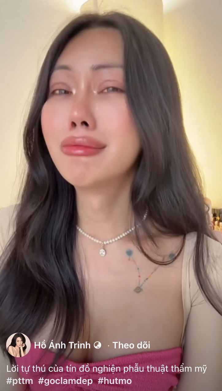 Mỹ nh&acirc;n chuyển giới An Giang kh&oacute;c l&oacute;c suy sụp sau khi ti&ecirc;m mỡ to&agrave;n mặt- Ảnh 4.