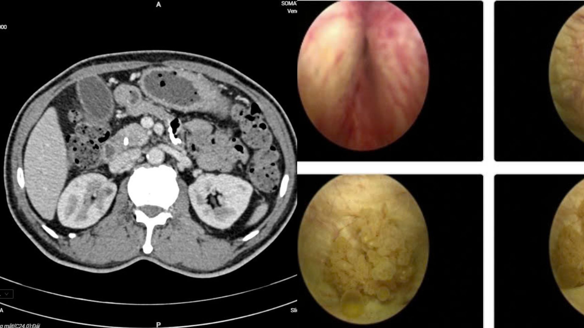Chỉ c&oacute; 2 dấu hiệu, người đ&agrave;n &ocirc;ng ph&aacute;t hiện c&ugrave;ng l&uacute;c 2 bệnh ung thư- Ảnh 1.