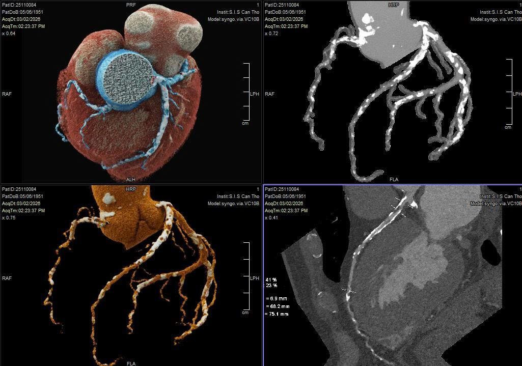 Bệnh nh&acirc;n tho&aacute;t nguy cơ &lsquo;thượng m&atilde; phong&rsquo; nhờ chia sẻ chuyện ph&ograve;ng the- Ảnh 1.
