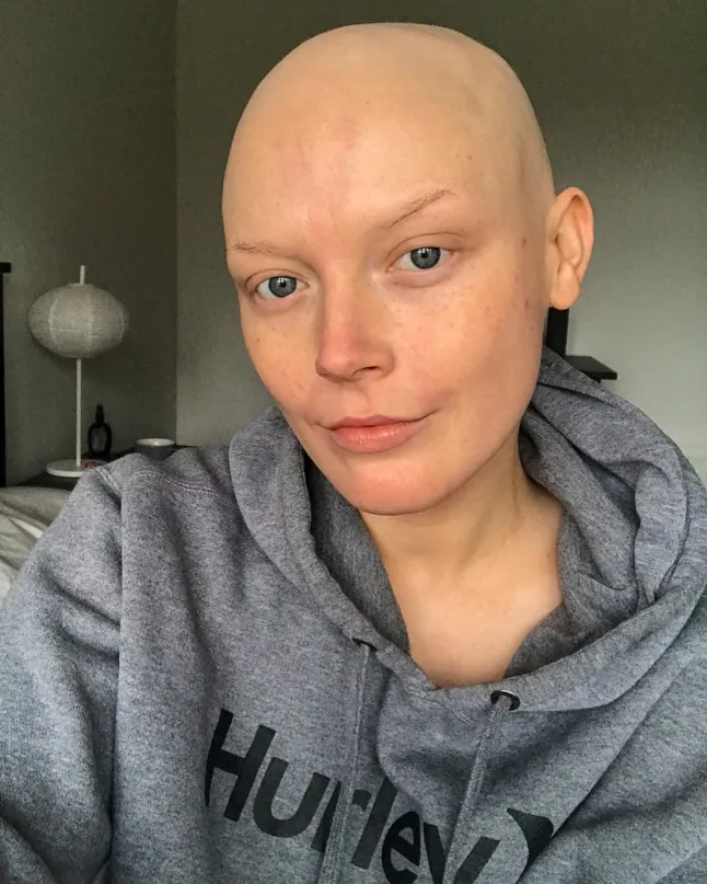 C&ocirc; g&aacute;i 26 tuổi 2 lần mắc ung thư ngậm ng&ugrave;i kể lại: "T&ocirc;i chỉ nghĩ đ&oacute; l&agrave; ngứa da th&ocirc;ng thường"- Ảnh 3.