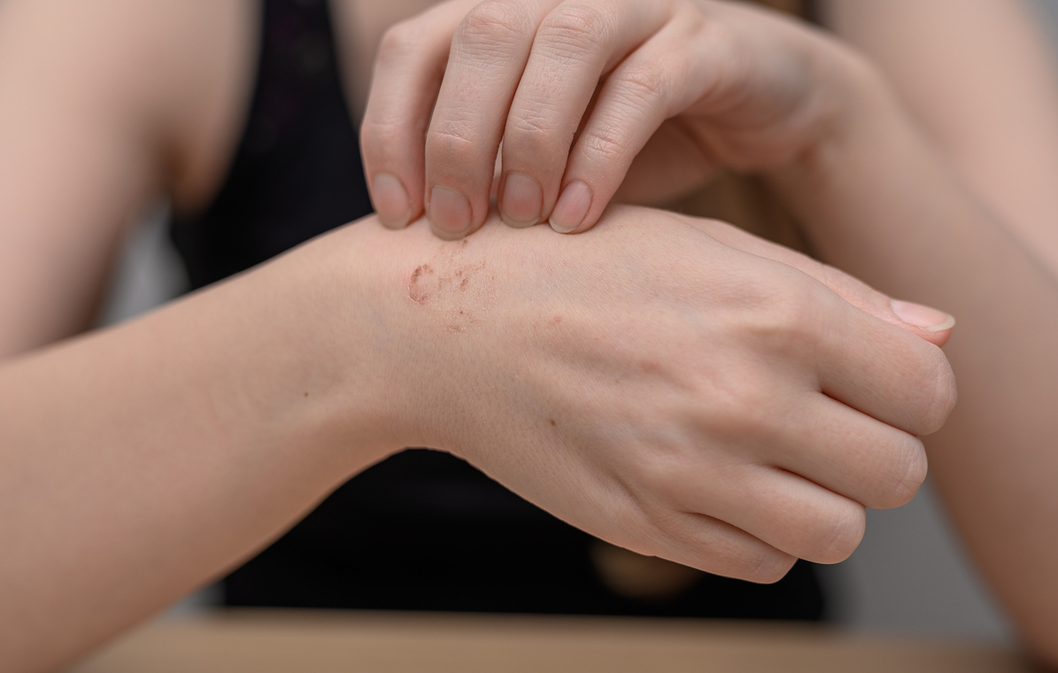 C&ocirc; g&aacute;i 26 tuổi 2 lần mắc ung thư ngậm ng&ugrave;i kể lại: "T&ocirc;i chỉ nghĩ đ&oacute; l&agrave; ngứa da th&ocirc;ng thường"- Ảnh 5.