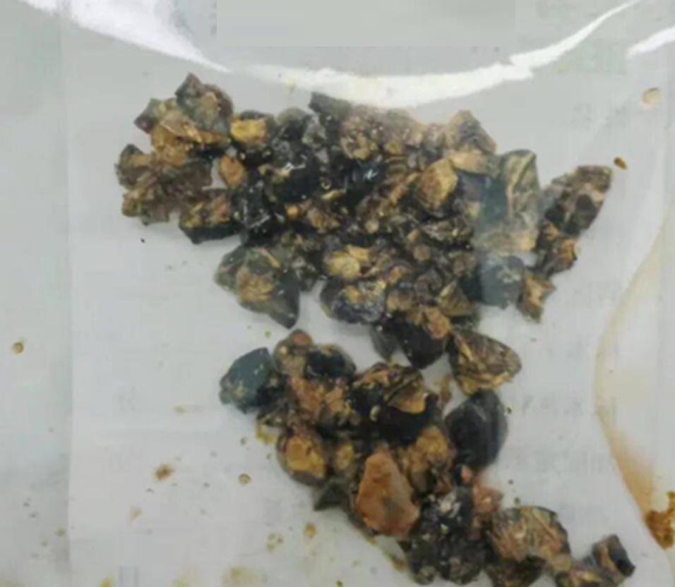 Nữ nh&acirc;n vi&ecirc;n văn ph&ograve;ng 35 tuổi cấp cứu v&igrave; đau bụng dữ dội, b&aacute;c sĩ ph&aacute;t hiện t&uacute;i mật vỡ, rơi ra 60 vi&ecirc;n...- Ảnh 1.