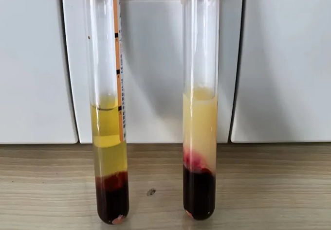 V&igrave; sao t&ocirc;i lu&ocirc;n kiểm so&aacute;t mỡ m&aacute;u nhưng khi kh&aacute;m lại vẫn kh&ocirc;ng cải thiện, thậm ch&iacute; bị nặng hơn?- Ảnh 1.