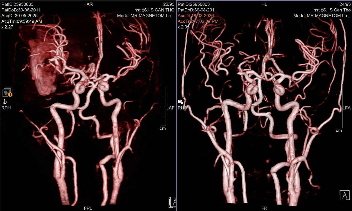 Cứu sống nam sinh h&ocirc;n m&ecirc; s&acirc;u do vỡ mạch m&aacute;u n&atilde;o- Ảnh 1.