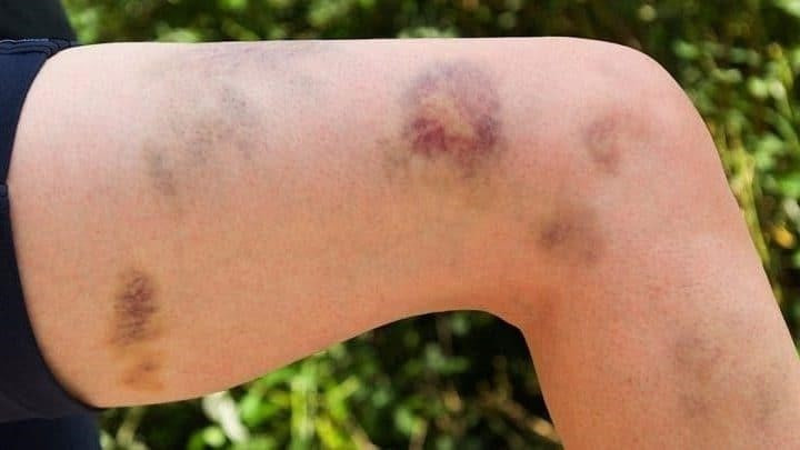 Tin thuốc 'l&agrave;nh t&iacute;nh', người phụ nữ rơi v&agrave;o nguy kịch v&igrave; bệnh hiếm- Ảnh 1.