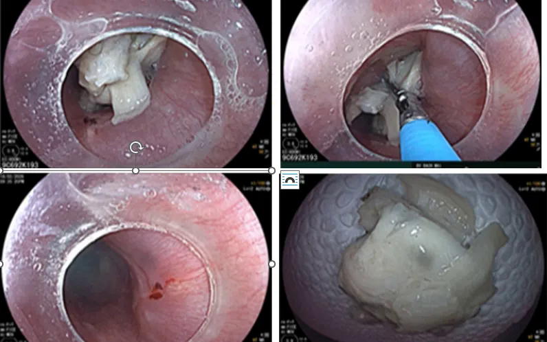 Li&ecirc;n tiếp 3 ca nuốt dị vật nguy hiểm dịp Tết- Ảnh 1.