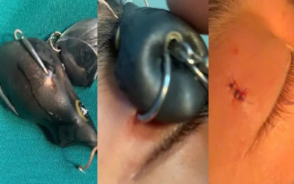 Tai nạn lưỡi c&acirc;u m&oacute;c v&agrave;o mắt, nguy cơ tổn thương nghi&ecirc;m trọng- Ảnh 1.