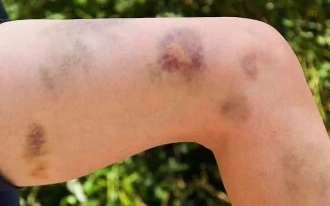 Vết bầm t&iacute;m tr&ecirc;n cơ thể l&agrave; một trong những dấu hiệu của bệnh TTP.