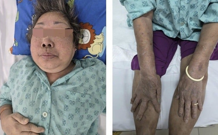 Tự &yacute; d&ugrave;ng thuốc giảm đau k&eacute;o d&agrave;i, cụ &ocirc;ng rơi v&agrave;o nguy kịch- Ảnh 1.