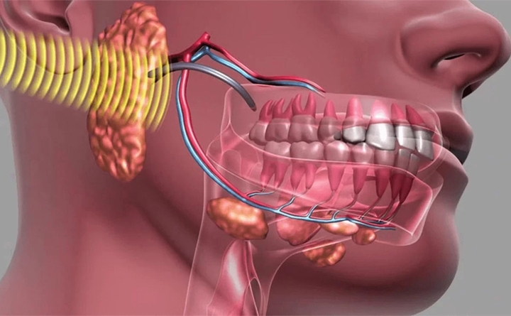 Bệnh u xương h&agrave;m nguy hiểm ra sao?- Ảnh 1.