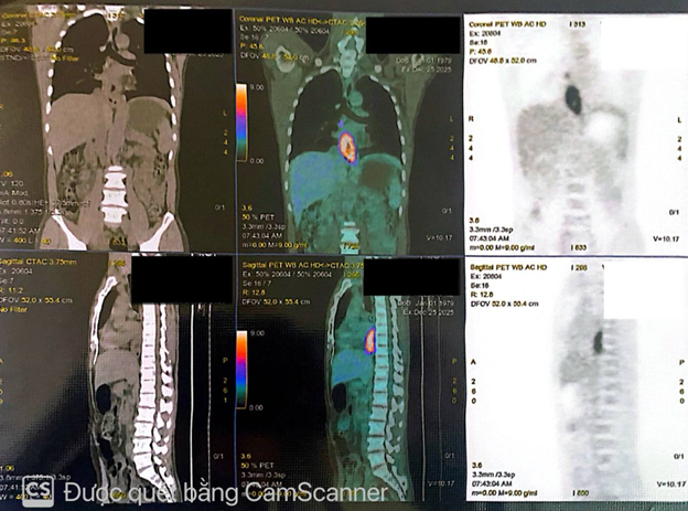 Người đ&agrave;n &ocirc;ng mắc đồng thời hai ung thư nguy hiểm- Ảnh 1.