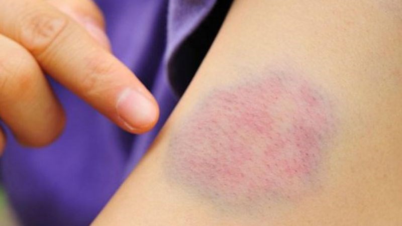 5 dấu hiệu nhỏ trên da "tố cáo" bệnh gan, nhiều người dễ xem thường- Ảnh 3. 5 dấu hiệu nhỏ trên da "tố cáo" bệnh gan, nhiều người dễ xem thường- Ảnh 3.