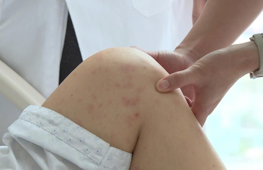 H&agrave; Nội: C&ocirc; gi&aacute;o mầm non vi&ecirc;m phổi do mắc thủy đậu, sai lầm v&igrave; 