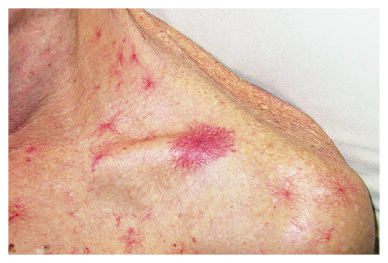 5 dấu hiệu nhỏ trên da "tố cáo" bệnh gan, nhiều người dễ xem thường- Ảnh 2. 5 dấu hiệu nhỏ trên da "tố cáo" bệnh gan, nhiều người dễ xem thường- Ảnh 2.