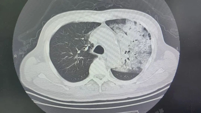 Người đ&agrave;n &ocirc;ng sốt 40 độ C, phổi gần như "trắng x&oacute;a", chỉ v&agrave;i ng&agrave;y đ&atilde; suy đa tạng: Thủ phạm li&ecirc;n quan đến th&oacute;i quen nhiều gia đ&igrave;nh vẫn mắc- Ảnh 1.