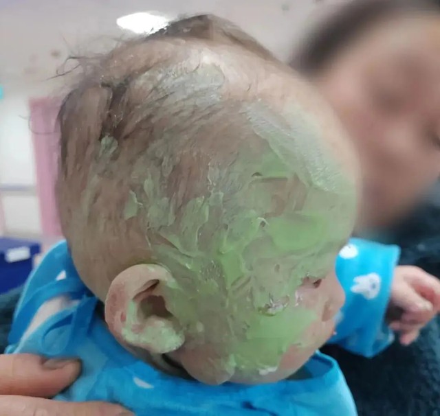 B&eacute; 1 tuổi bị bỏng mặt, gia đ&igrave;nh b&ocirc;i đầy kem đ&aacute;nh răng theo &ldquo;mẹo d&acirc;n gian&rdquo;: B&aacute;c sĩ cảnh b&aacute;o c&oacute; thể g&acirc;y nhiễm tr&ugrave;ng nặng- Ảnh 1.