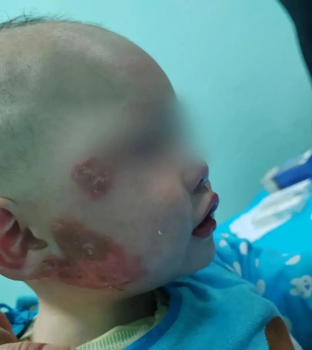 B&eacute; 1 tuổi bị bỏng mặt, gia đ&igrave;nh b&ocirc;i đầy kem đ&aacute;nh răng theo &ldquo;mẹo d&acirc;n gian&rdquo;: B&aacute;c sĩ cảnh b&aacute;o c&oacute; thể g&acirc;y nhiễm tr&ugrave;ng nặng- Ảnh 2.