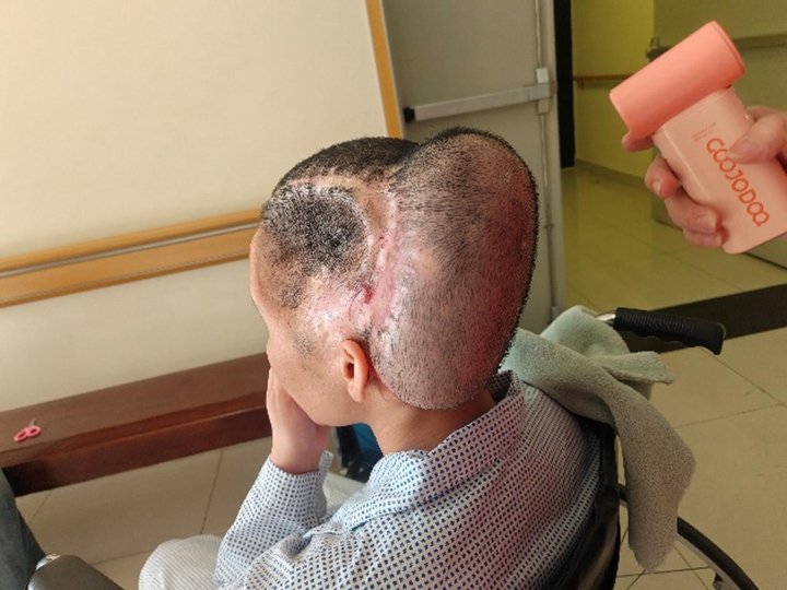 Đột quỵ sau h&uacute;t mỡ l&agrave;m đẹp- Ảnh 1.