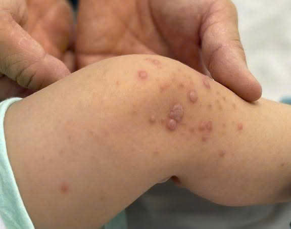 Bệnh tay chân miệng tăng nhanh, bác sĩ cảnh báo nóng- Ảnh 1. Bệnh tay chân miệng tăng nhanh, bác sĩ cảnh báo nóng- Ảnh 1.