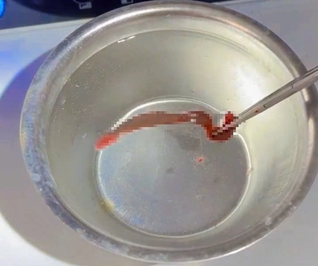 Người đ&agrave;n &ocirc;ng 53 tuổi chảy m&aacute;u mũi li&ecirc;n tục, b&aacute;c sĩ ph&aacute;t hiện ra thứ "đ&aacute;ng sợ" ẩn n&aacute;u b&ecirc;n trong- Ảnh 2.