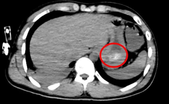 Ch&agrave;ng trai 24 tuổi phải rửa ruột v&igrave; s&aacute;ng tỉnh dậy bỗng c&oacute; 150 vi&ecirc;n thuốc trong bụng - Ảnh 2.