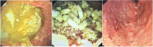 Ch&agrave;ng trai 24 tuổi phải rửa ruột v&igrave; s&aacute;ng tỉnh dậy bỗng c&oacute; 150 vi&ecirc;n thuốc trong bụng - Ảnh 3.