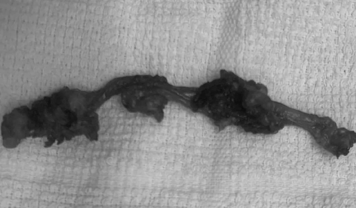 Đau &acirc;m ỉ v&ugrave;ng bụng, người đ&agrave;n &ocirc;ng sốc nặng khi b&aacute;c sĩ lấy ra thứ "rợn người" trong cơ thể - Ảnh 1.