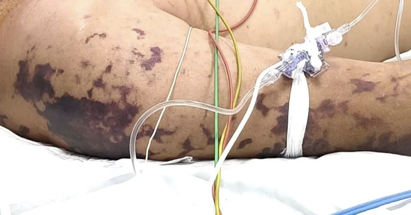 N&atilde;o m&ocirc; cầu tăng mạnh, trẻ em chiếm gần 50% ca mắc, nhận diện dấu hiệu 'tử thần' - Ảnh 1.