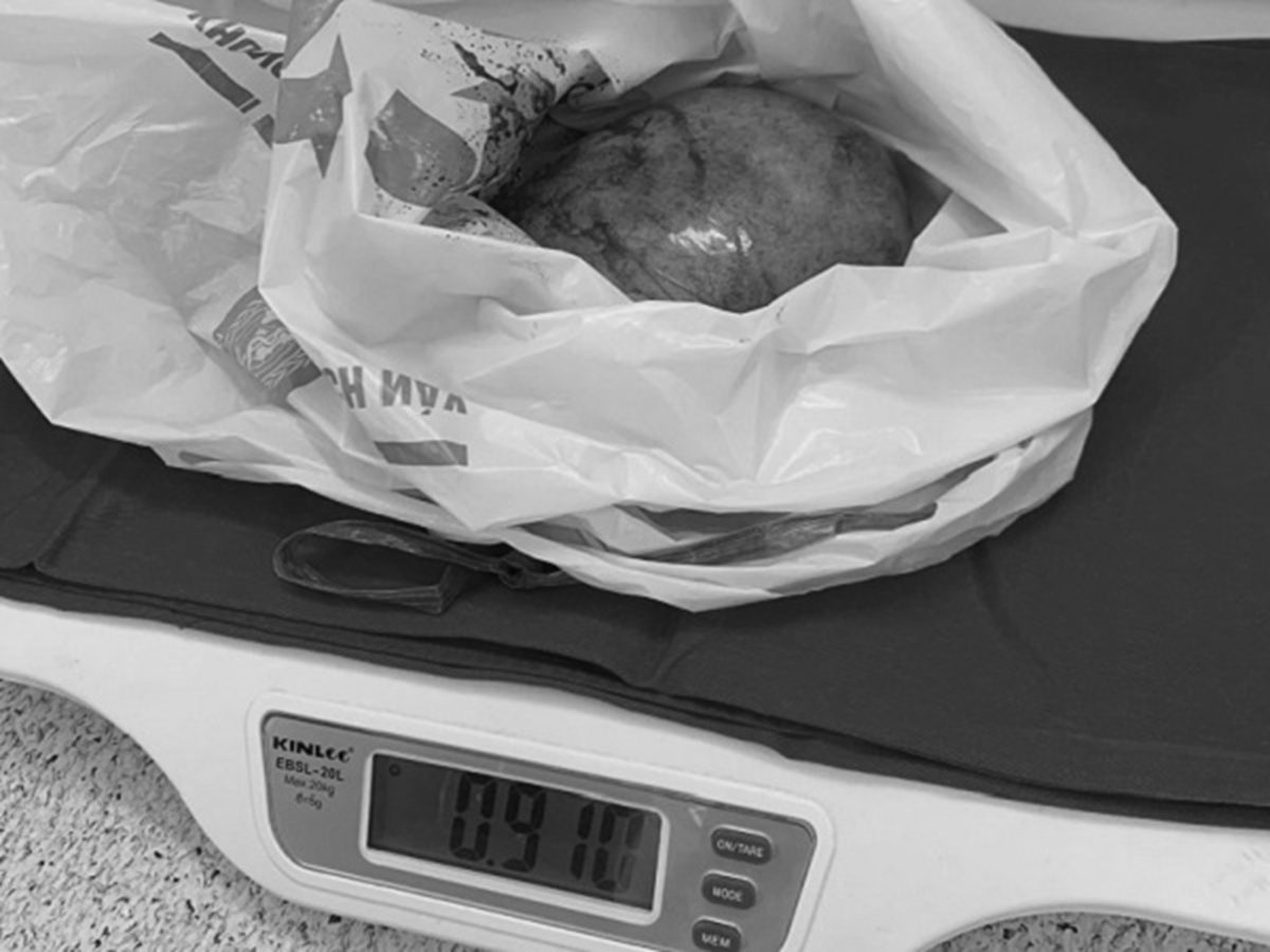 Đau bụng tưởng nhẹ, người phụ nữ sốc nặng khi b&aacute;c sĩ lấy ra thứ &ldquo;đ&aacute;ng sợ&rdquo; trong bụng - Ảnh 1.