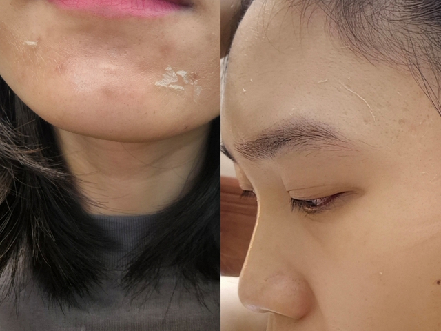 Peel da kh&ocirc;ng phải &ldquo;cứ l&agrave;m l&agrave; đẹp&rdquo;: Chuy&ecirc;n gia cảnh b&aacute;o 4 sai lầm khiến da c&agrave;ng ng&agrave;y c&agrave;ng tệ- Ảnh 4.