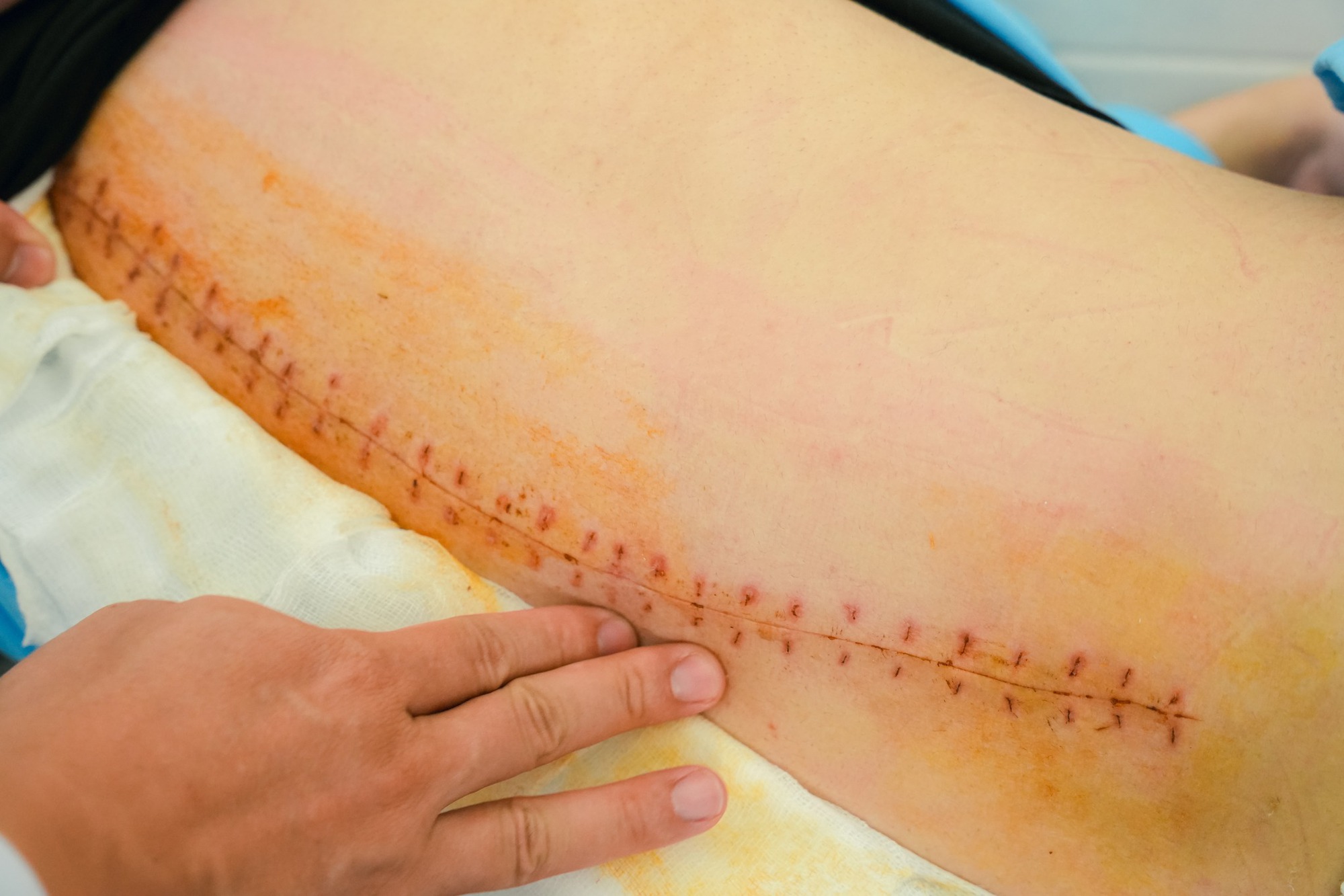 Soi gương thấy lưng c&oacute; dấu hiệu lạ, c&ocirc; g&aacute;i 18 tuổi sốc khi biết cột sống đ&atilde; cong 53 độ - Ảnh 3.