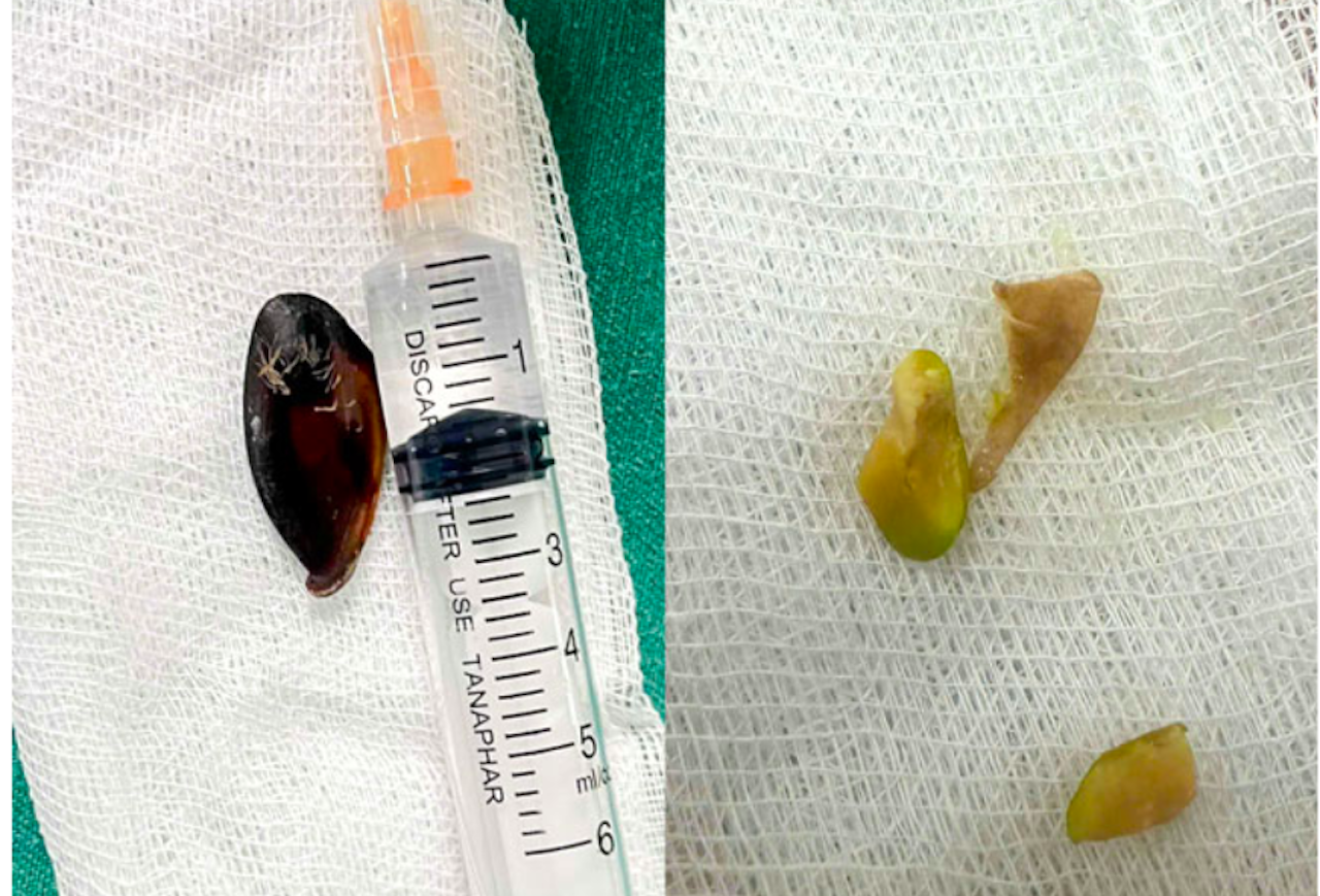 B&eacute; 14 tuổi ho khan k&eacute;o d&agrave;i, gia đ&igrave;nh sốc khi b&aacute;c sĩ lấy ra dị vật b&ecirc;n trong cơ thể- Ảnh 1.