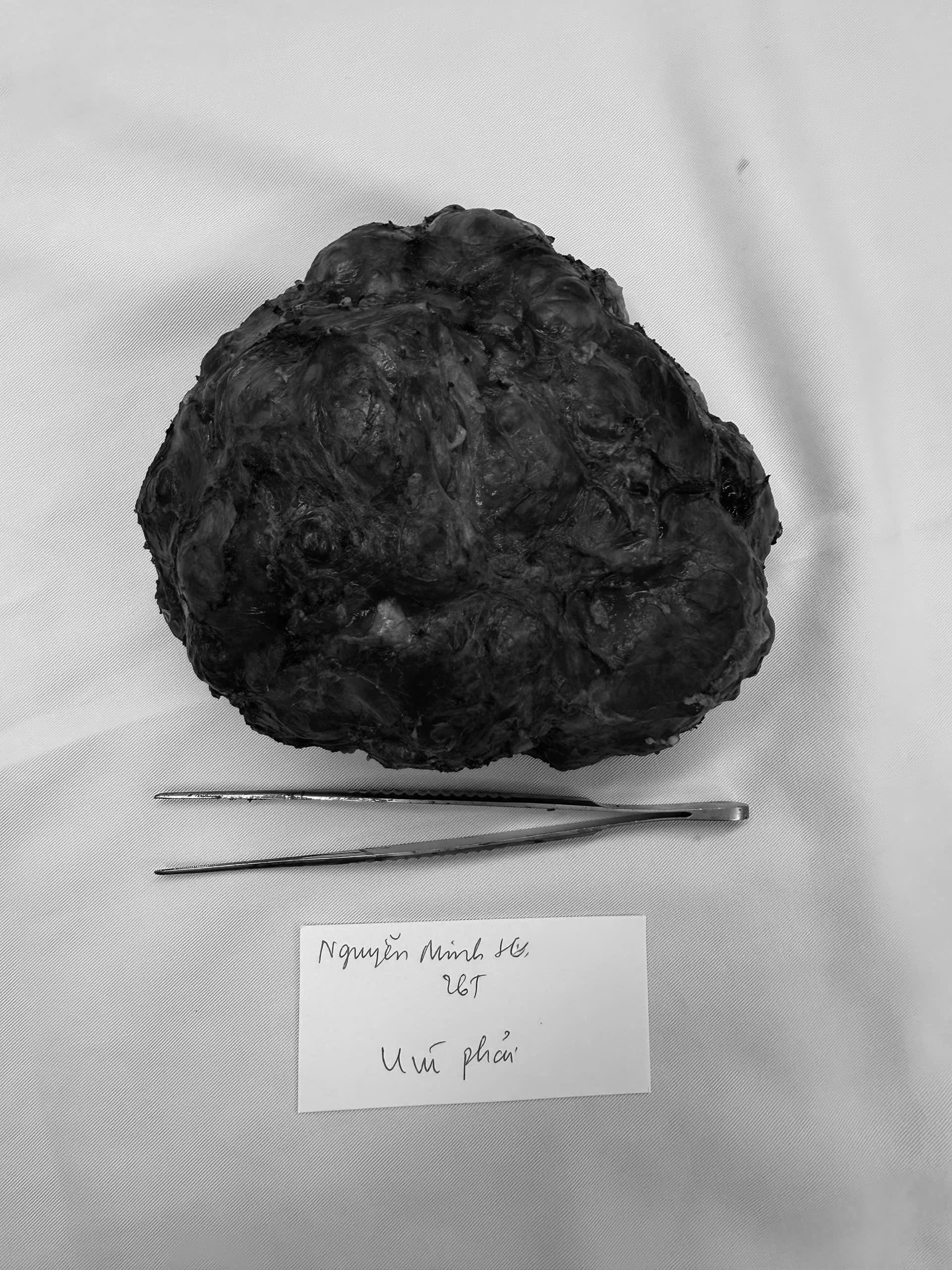 C&ocirc; g&aacute;i trẻ 26 tuổi v&ograve;ng một to bất thường, b&aacute;c sĩ ph&aacute;t hiện b&iacute; mật b&ecirc;n trong - Ảnh 1.